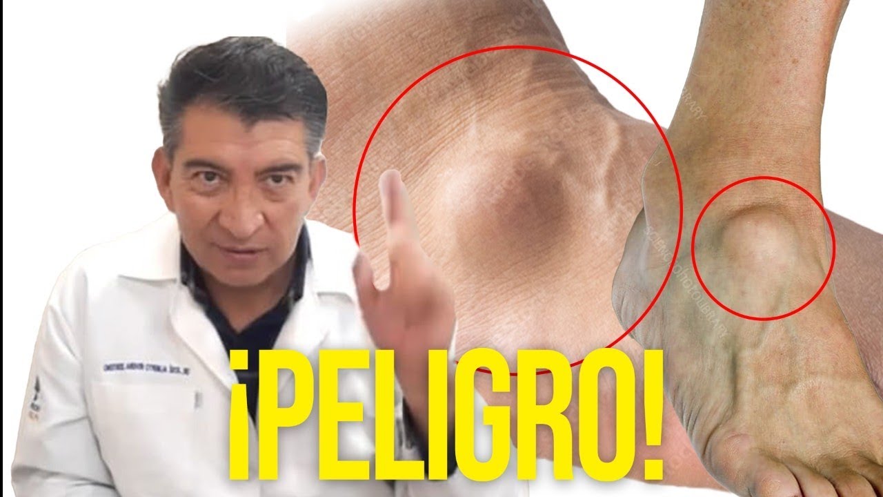 bulto en el empeine del pie