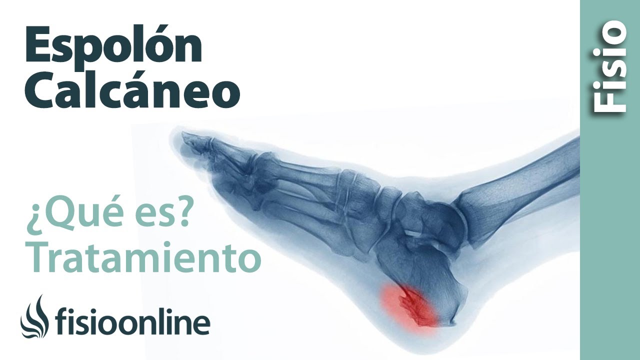 como es el dolor de espolon calcaneo