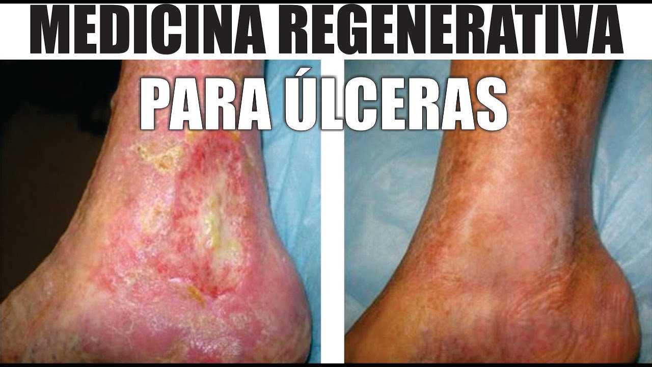 como se curan las llagas de los pies