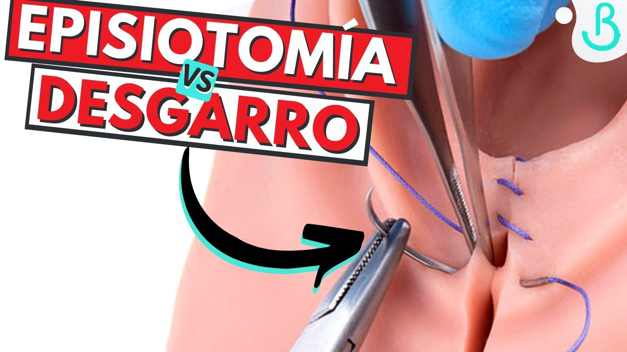 como te cosen despues del parto