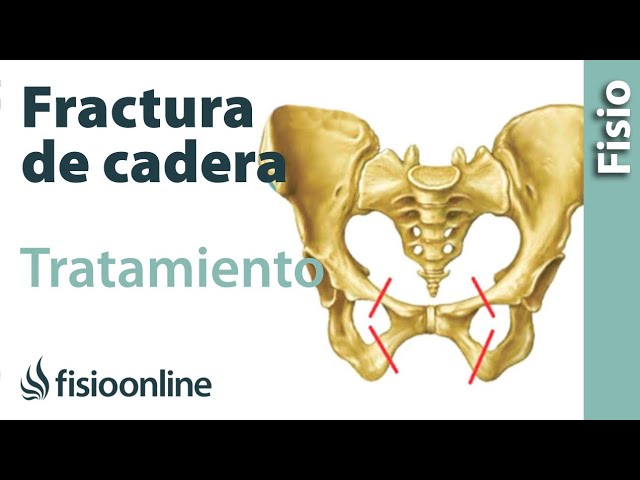 como tratar una fisura en la pelvis