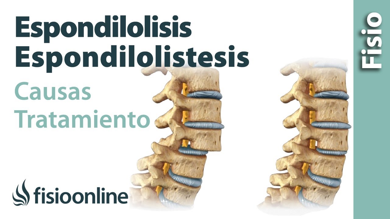 desplazamiento de vertebras l4 y l5