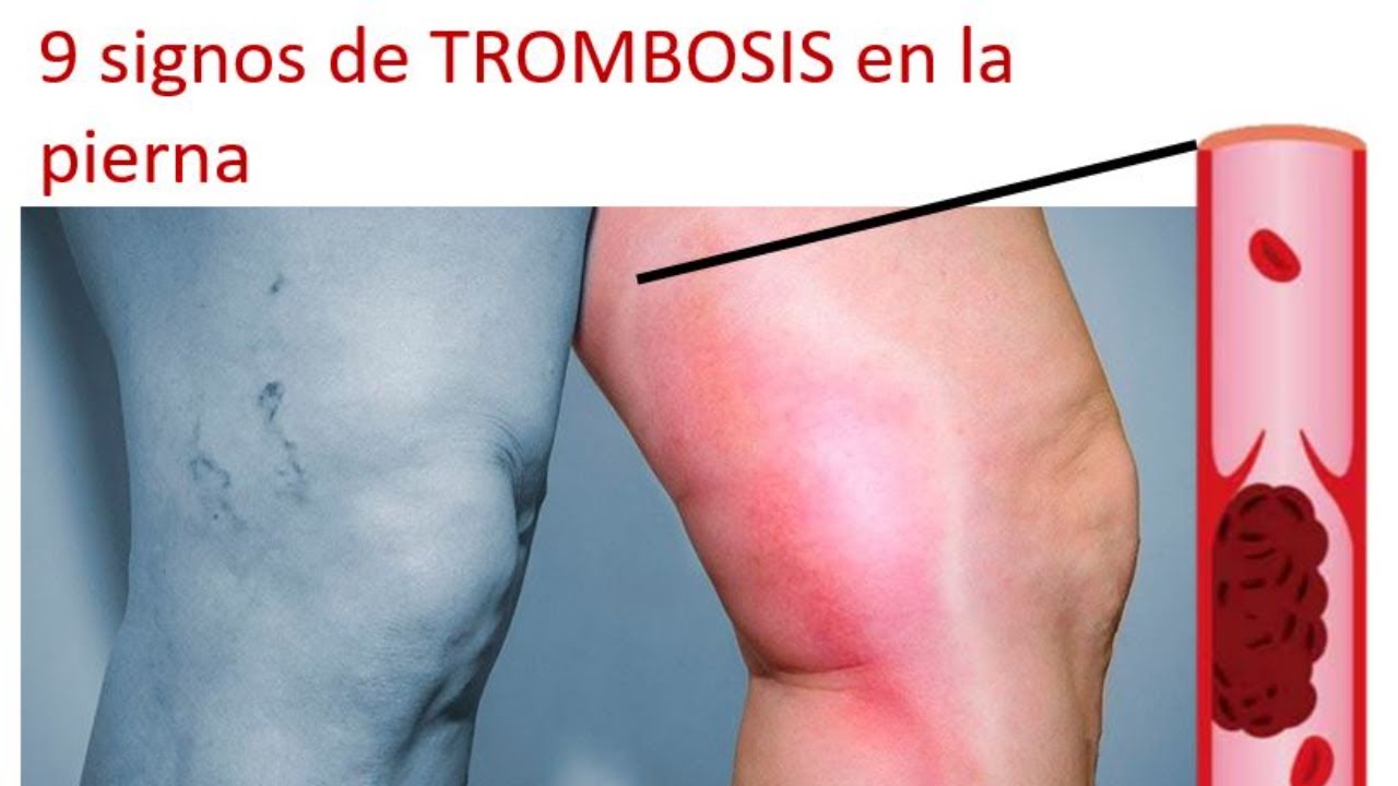 dolor detrás de la rodilla trombosis