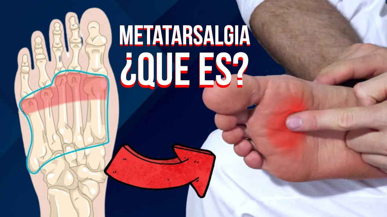 dolor en los metatarsos del pie