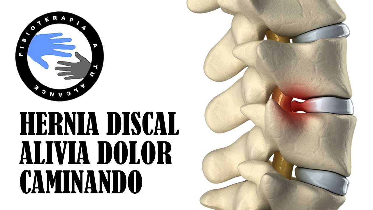 es bueno andar con hernia discal
