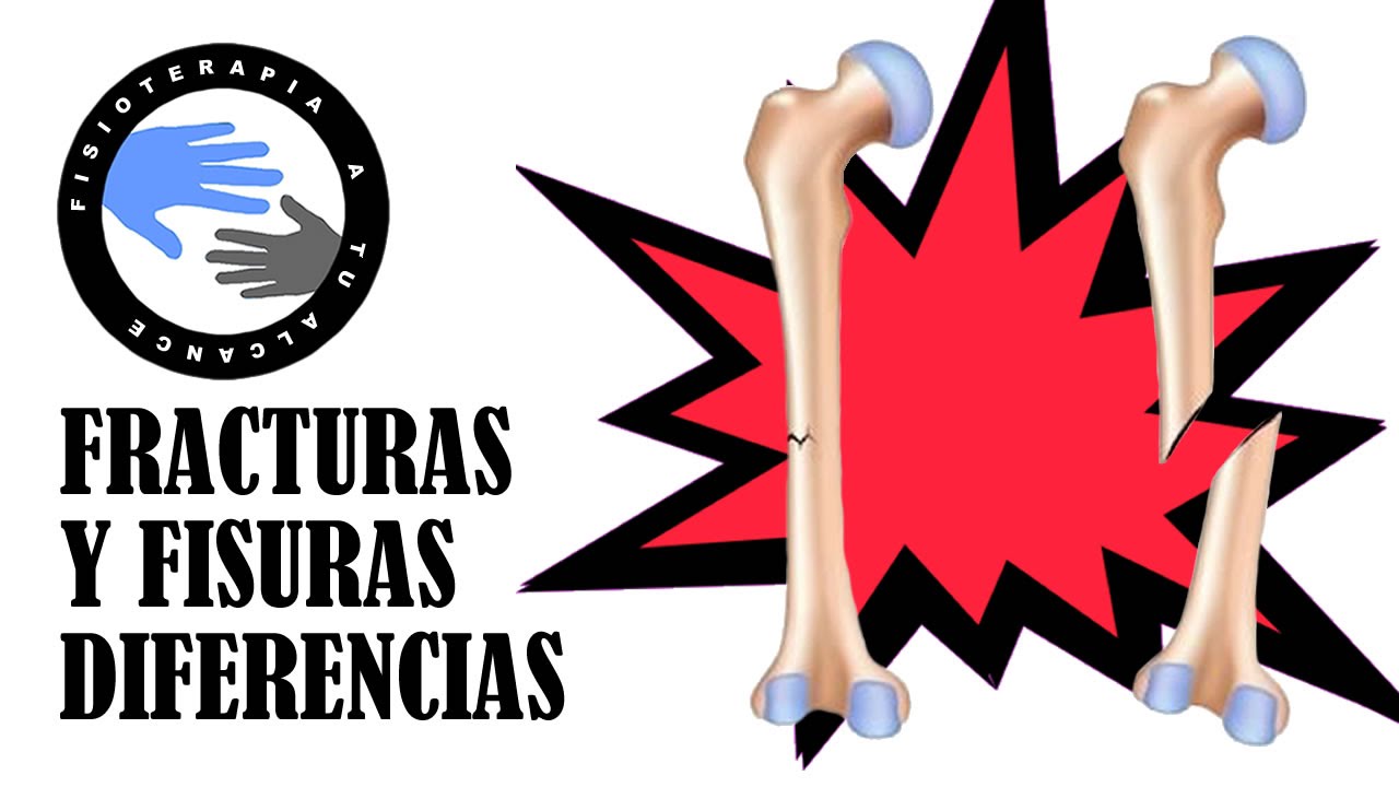 es lo mismo fisura que fractura