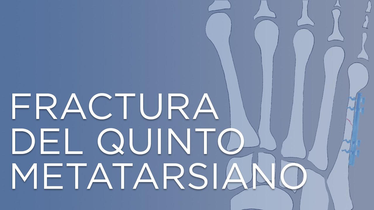 fisura del quinto metatarsiano tiempo de recuperacion