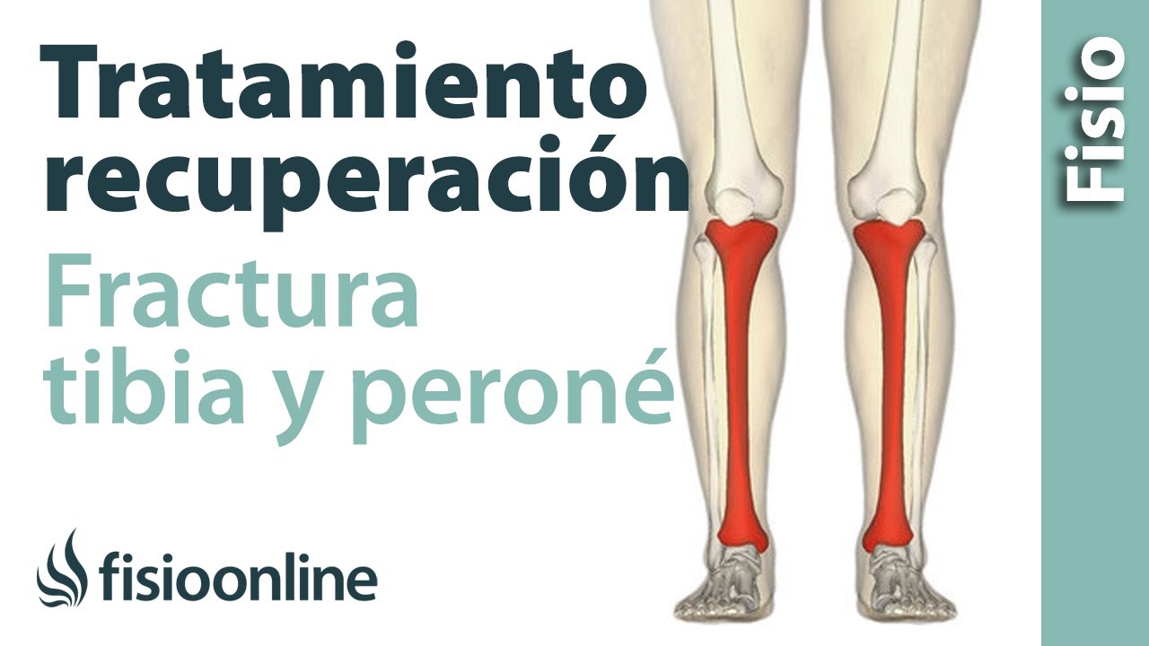 fractura de perone tiempo para caminar