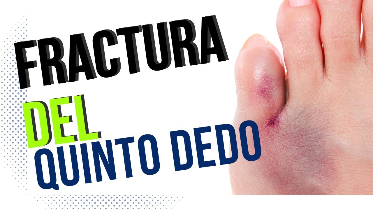 fractura del dedo meñique del pie derecho