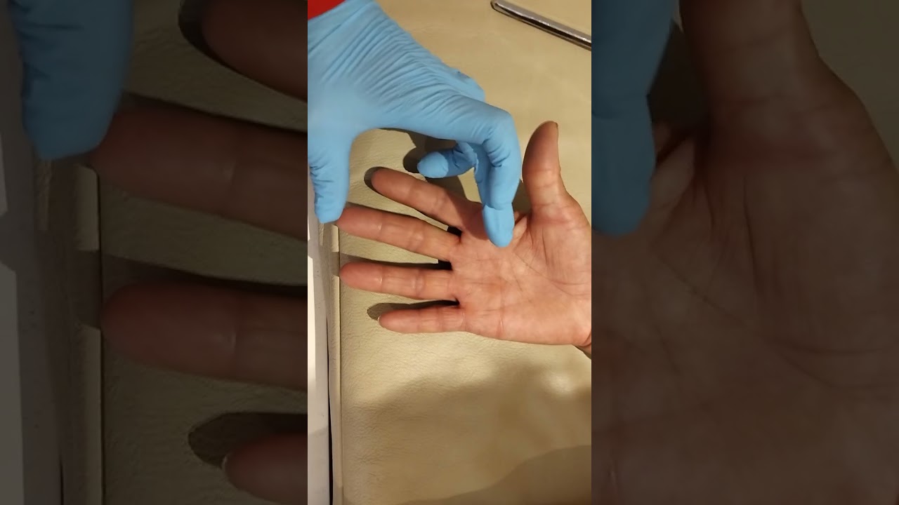inflamacion en la palma de la mano