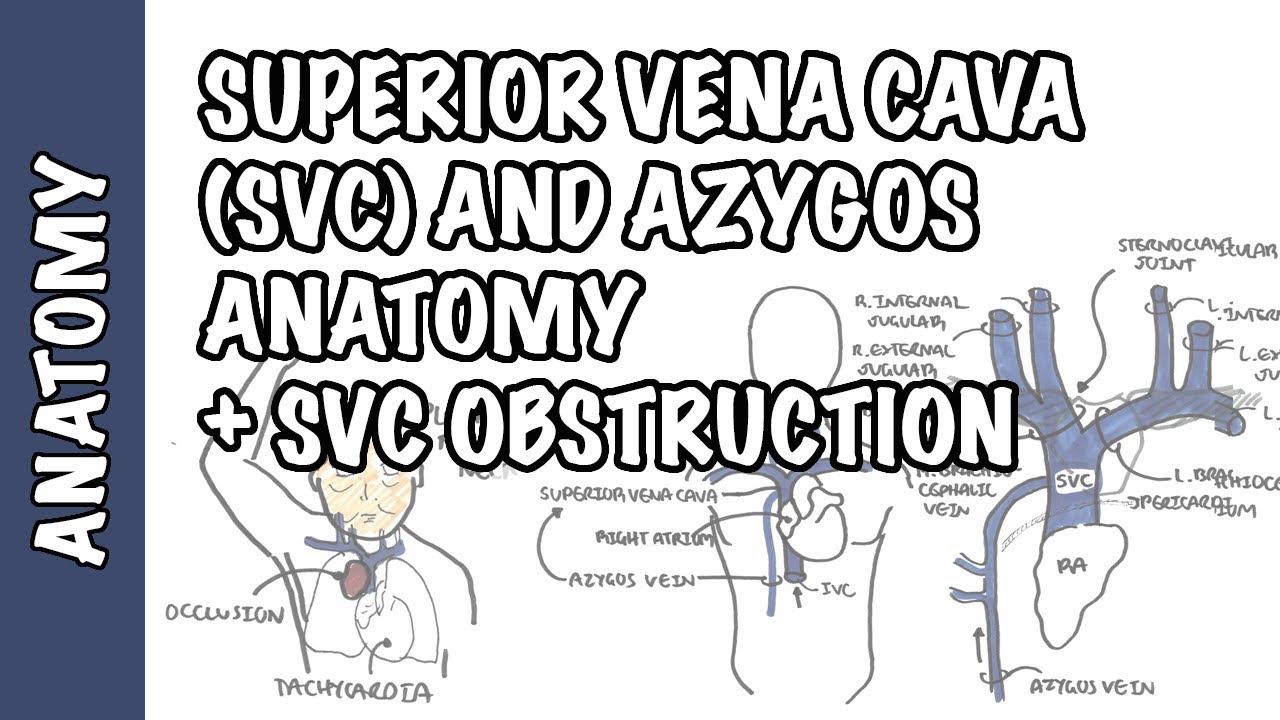 obstruccion de la vena cava inferior