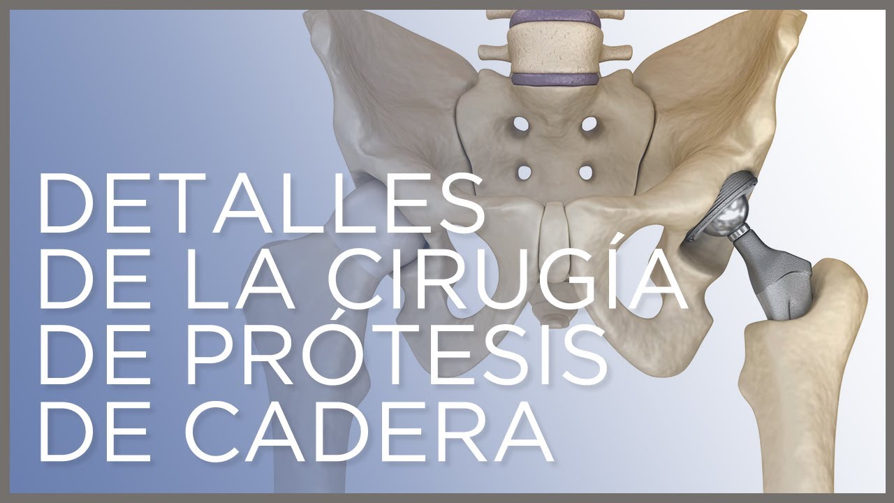 operacion de cadera y femur recuperacion