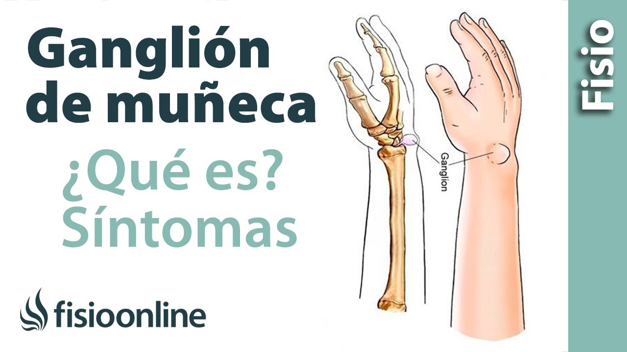 porque sale una bola en la muñeca dela mano