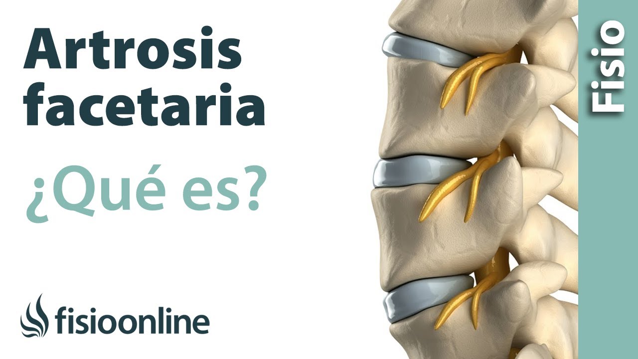 que es la artrosis facetaria l4 l5 y l5 s1