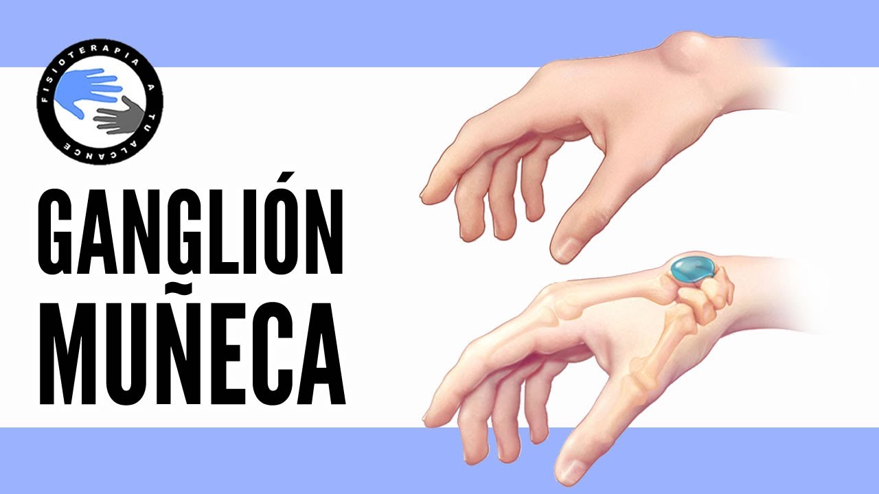 quistes en los tendones de la mano