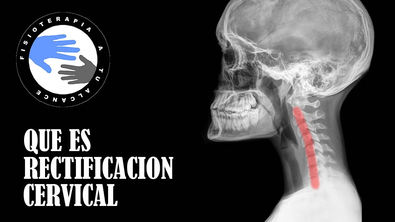 rectificación de la lordosis cervical fisiológica