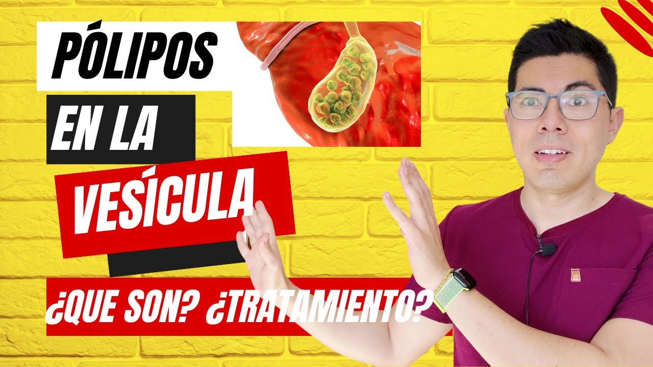 remedios para polipos en la vesicula