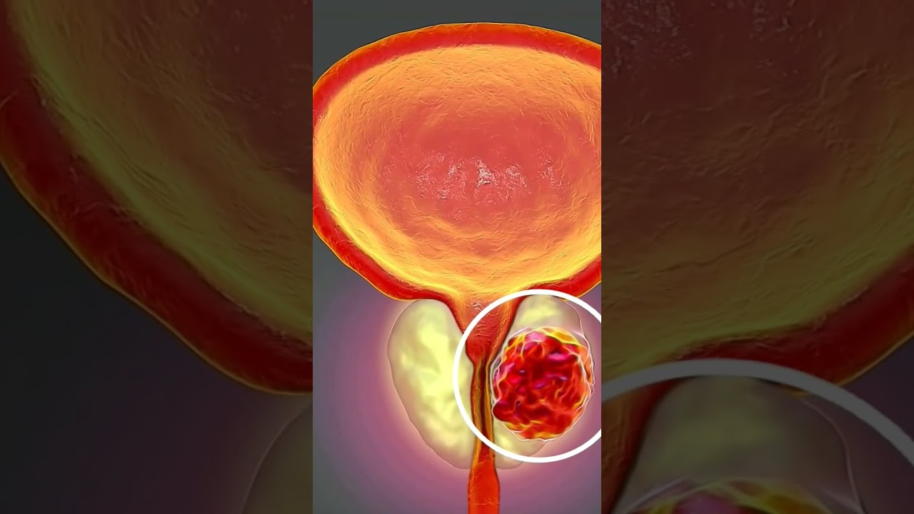 alimentos perjudiciales para la prostata inflamada