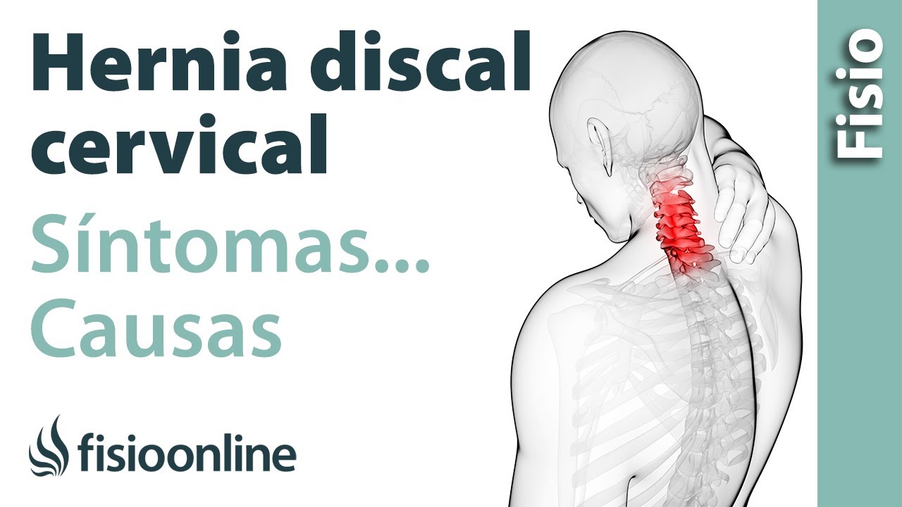 como saber si tengo una hernia cervical