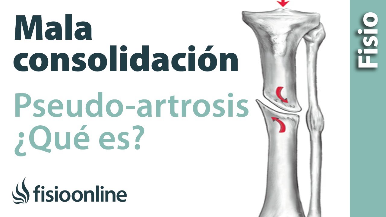 consolidacion de fracturas en adultos mayores