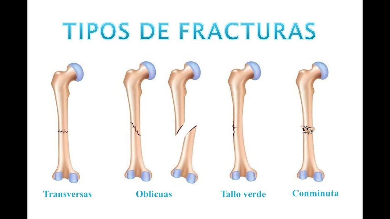 cuales son los tipos de fracturas
