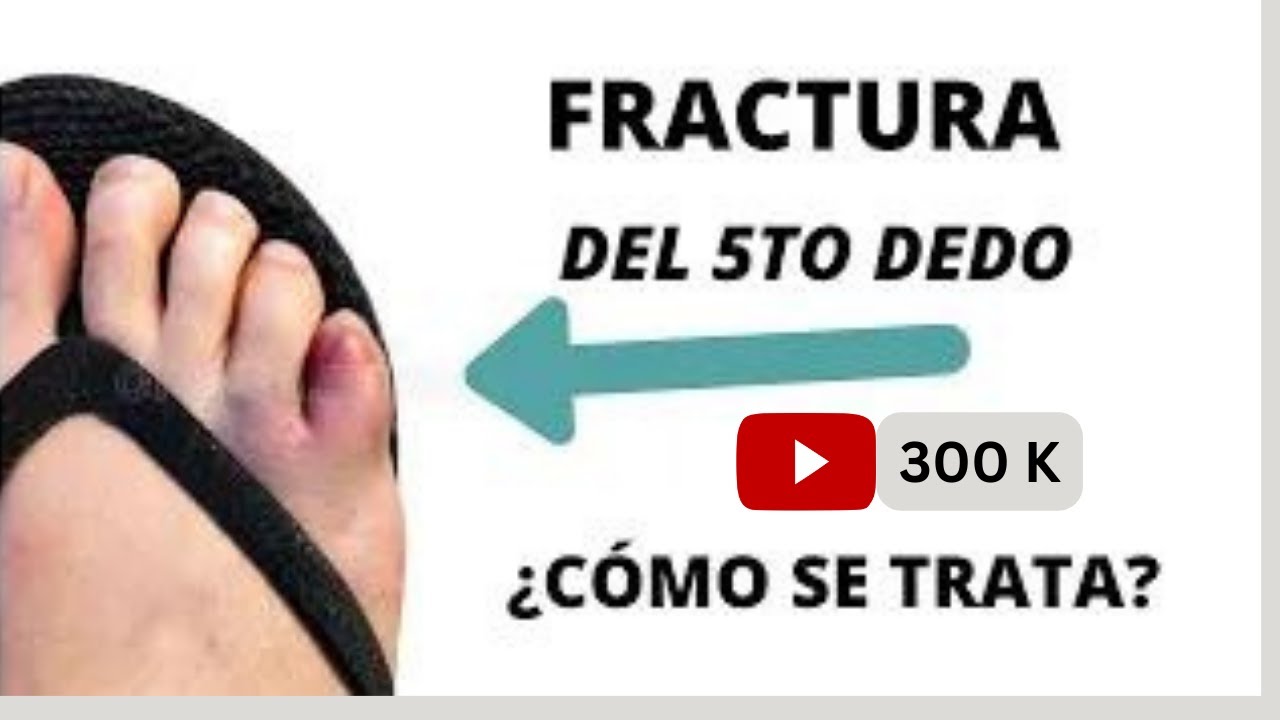 dedo del pie roto mal curado
