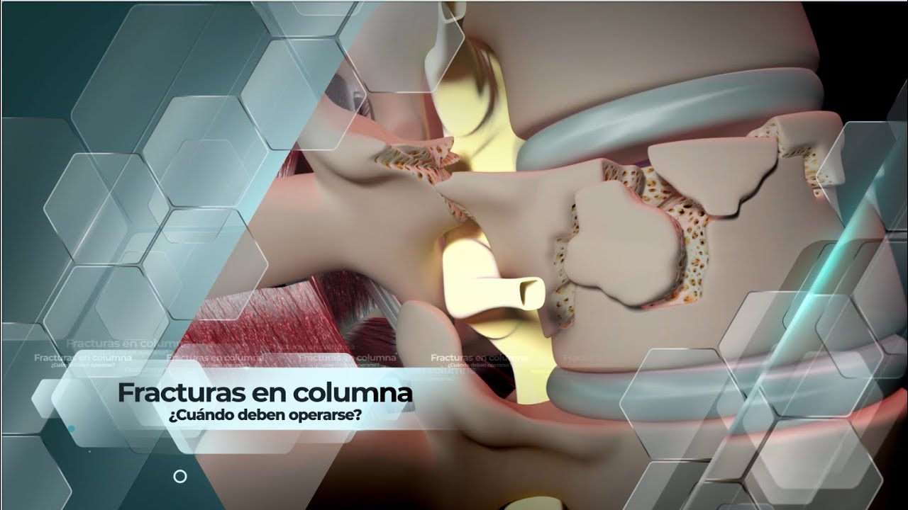 fractura en cuña de cuerpos vertebrales