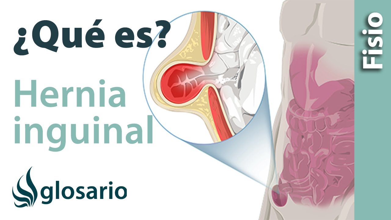 hernia en la ingle mujer sintomas