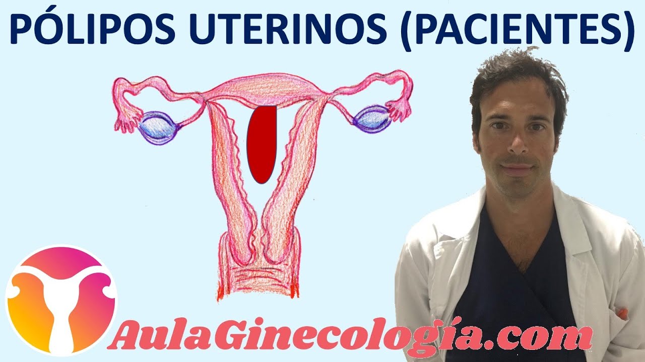 los polipos en el utero duelen