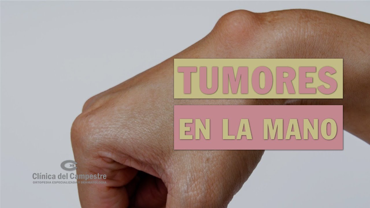 nodulos en la muñeca dela mano