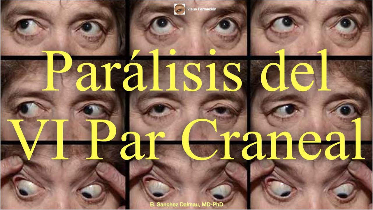 paralisis del sexto par craneal tratamiento