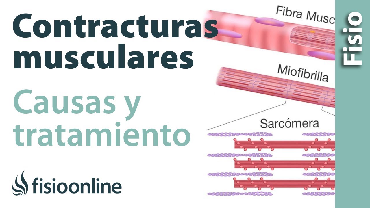 que es una contractura muscular en la rodilla