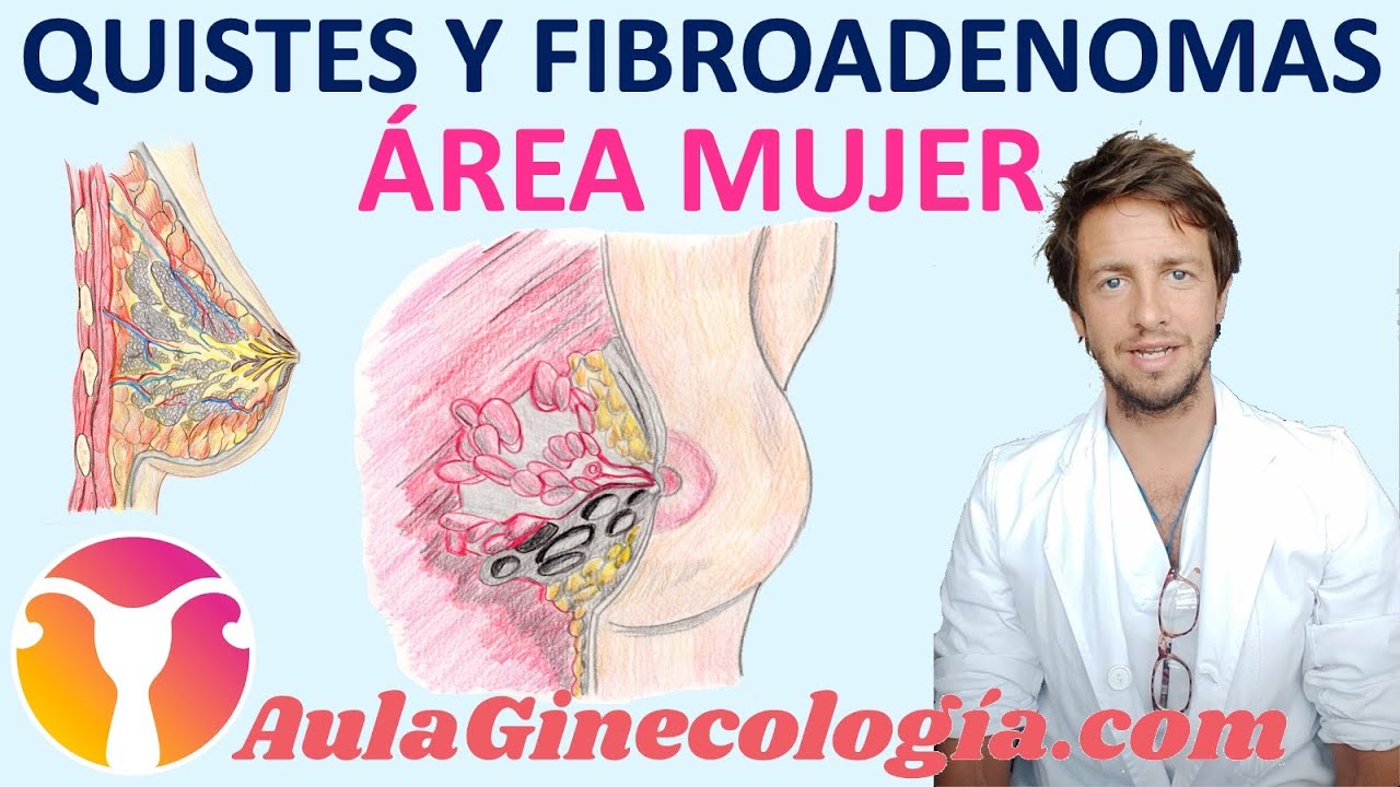 quiste en la areola del pezon