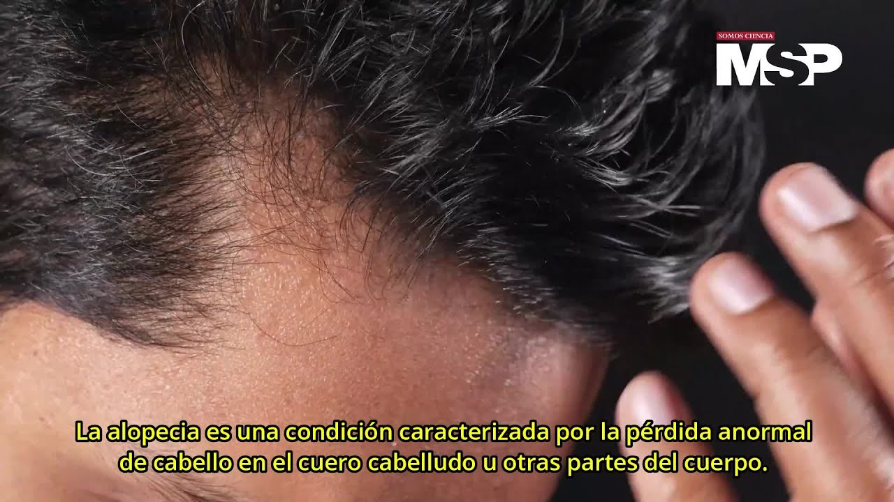 alopecia por tracción antes y después