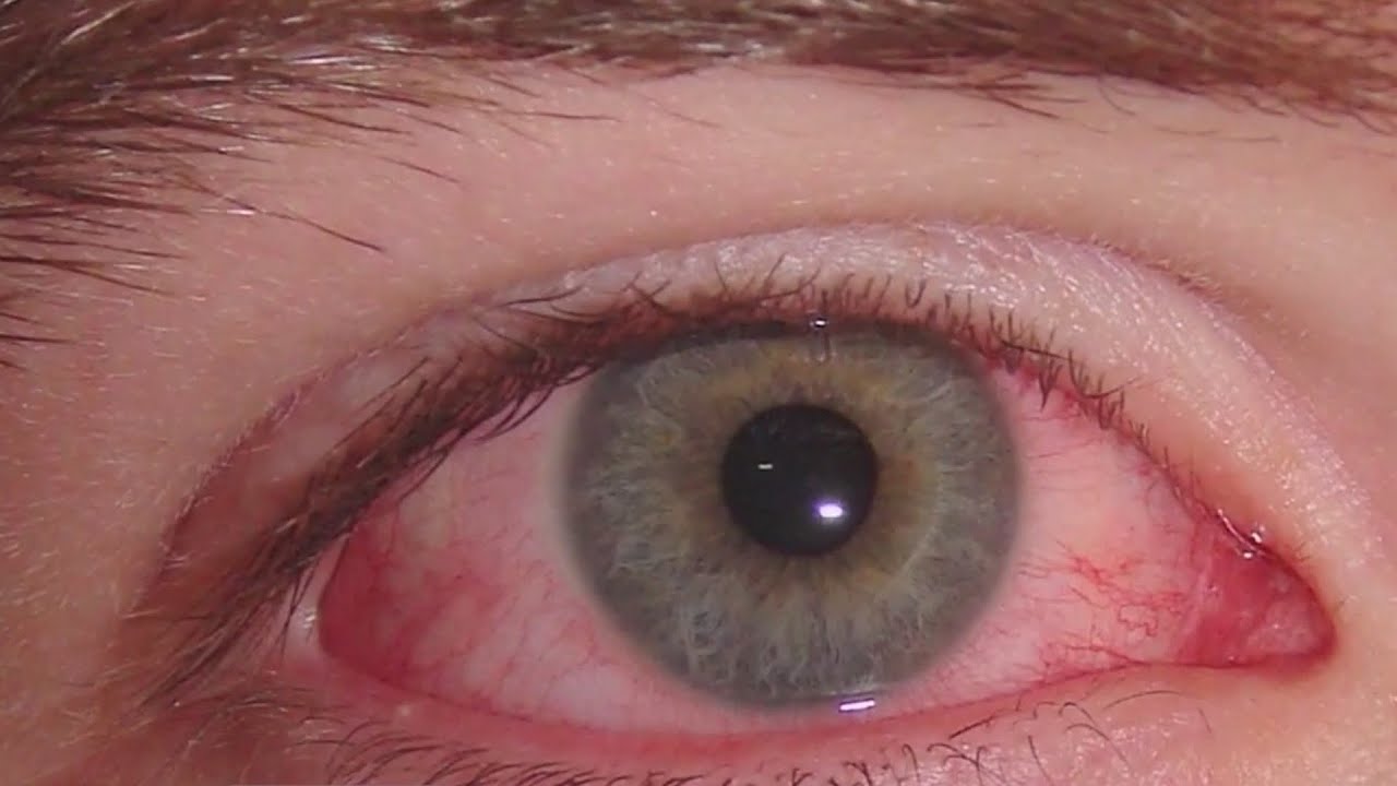 cuanto dura la conjuntivitis por covid