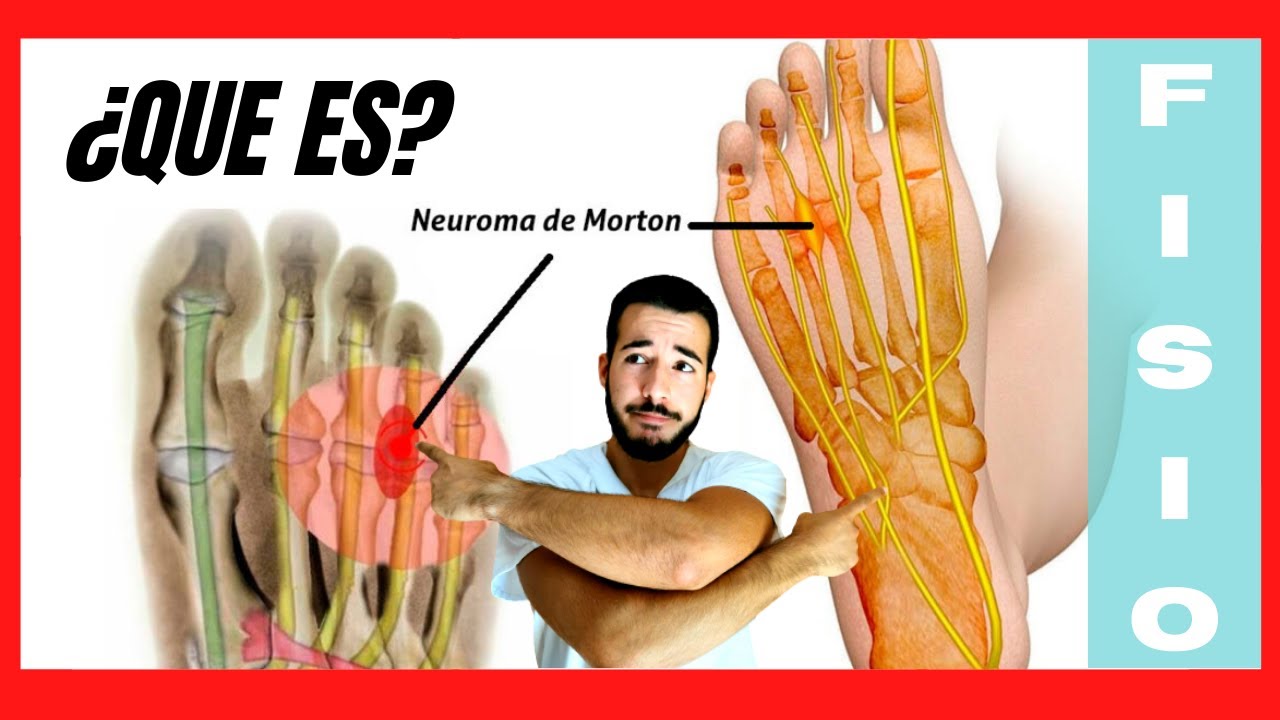 enfermedad de morton en los pies