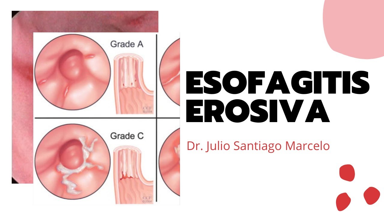 esofagitis grado b de los ángeles
