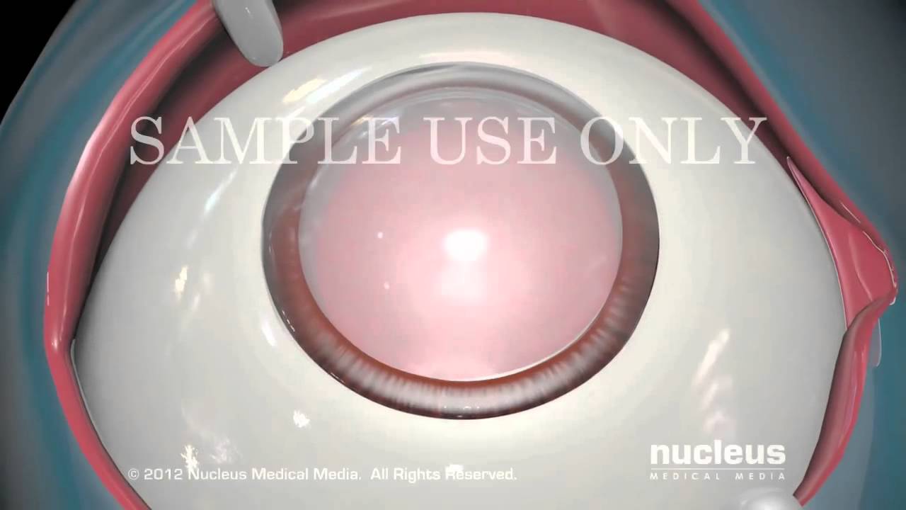 facoemulsificación con implante de lente intraocular