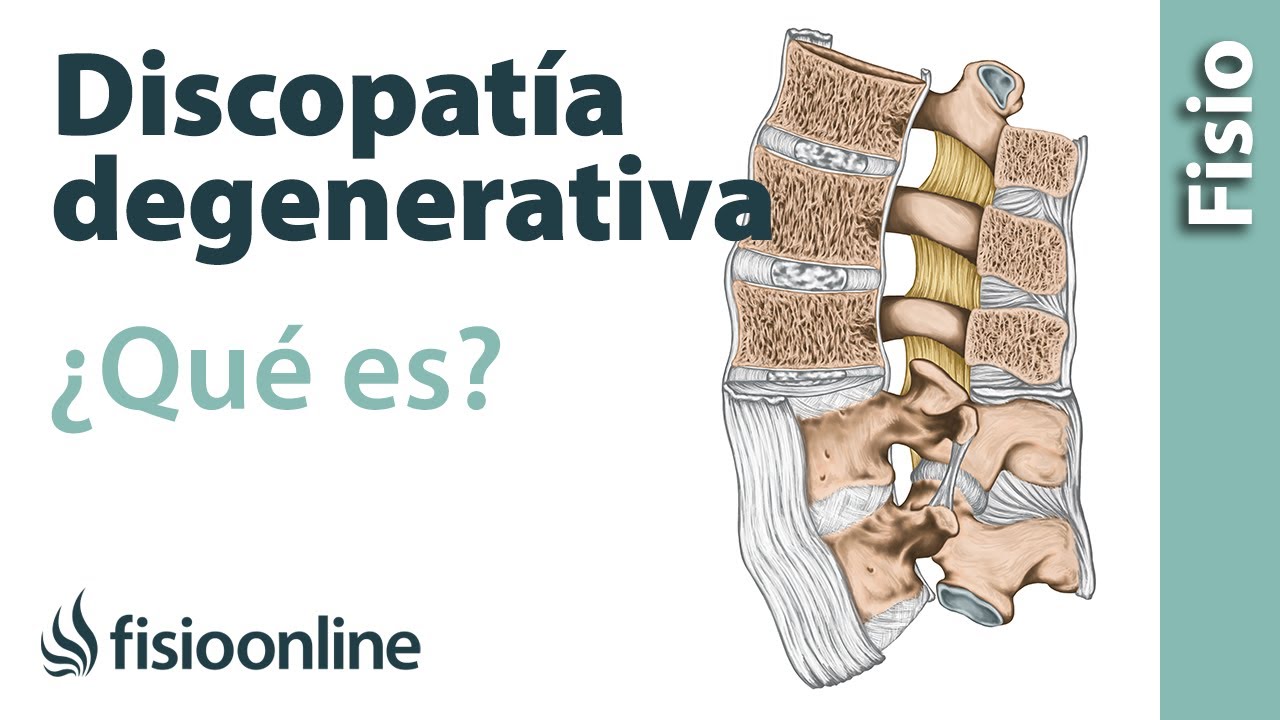 grado de discapacidad por discopatía degenerativa cervical