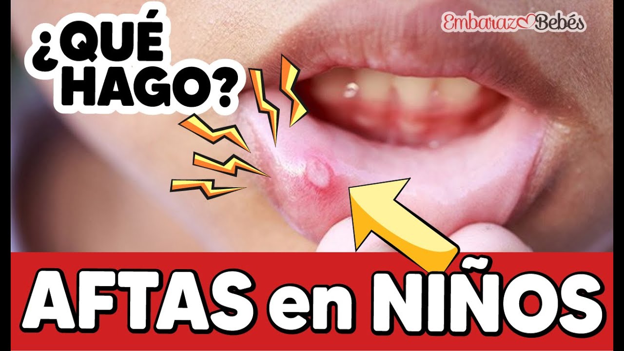 llagas en la lengua niños 2 años