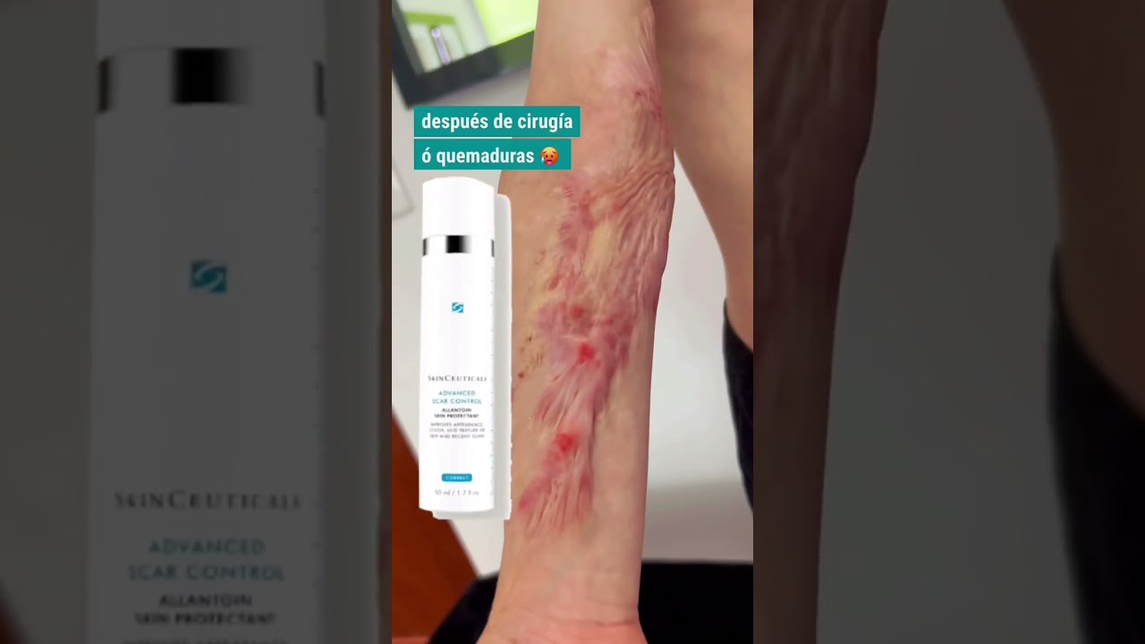 lo mejor para eliminar cicatrices quirúrgicas