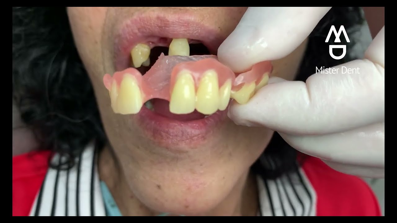 lo último en prótesis dentales removibles