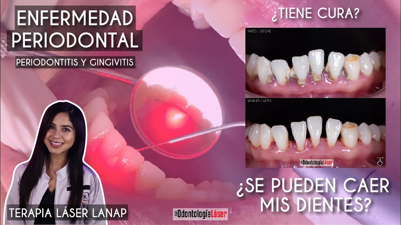 mi experiencia con el láser periodontal