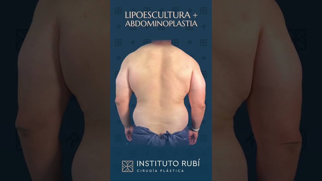 operación de barriga antes y después