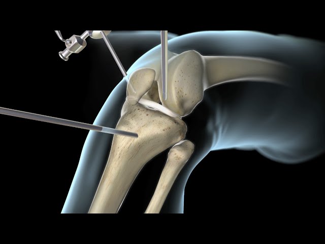 operacion de meñisco y ligamento cruzado