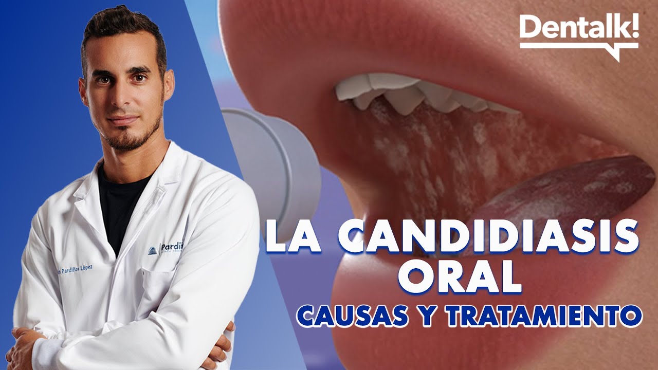 porque salen hongos en la lengua