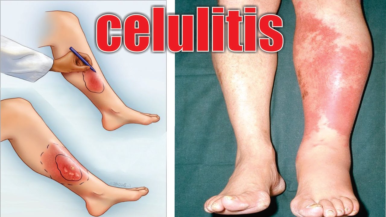 se puede caminar con celulitis infecciosa