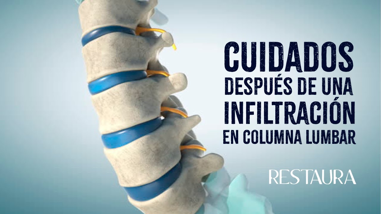 se puede caminar después de una infiltración lumbar