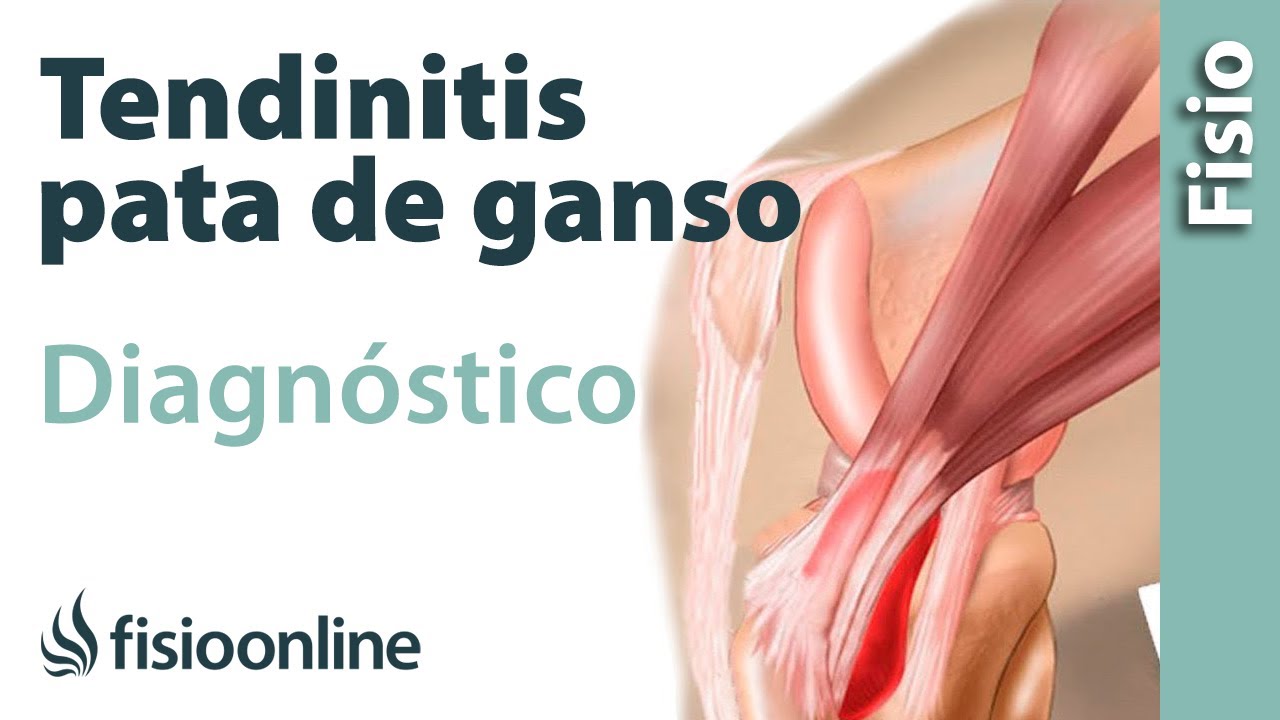 tendinitis de la pata de ganso sintomas