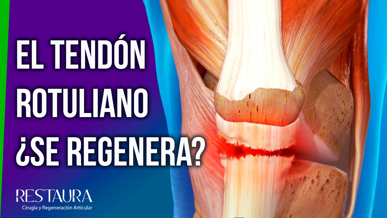 tendón rotuliano roto tiempo de recuperación